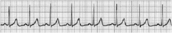 The nurse receives the following ECG strip at shift report. Which action is most appropriate for this patient?   A)  Place the patient on oxygen at 2 L/min via nasal cannula. B)  Give atropine 1 mg IVP per protocol. C)  Start a second IV for normal saline bolus per protocol. D)  Assess the patient.