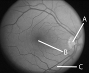 The letter  B  in the above figure represents   A) cortex. B) cornea. C) fovea. D) blood vessels. E) optic nerve.