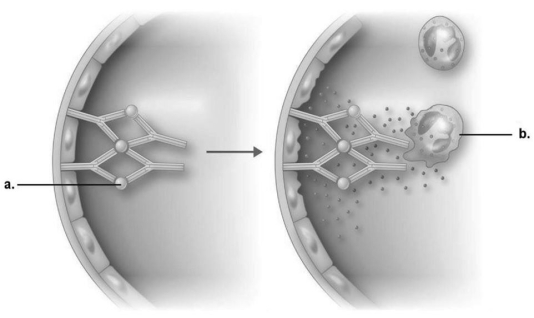 Figure 19.1    -In immune complex reaction shown in Figure 19.1,what is the end result of the reaction? A) IgG is directed against cell membrane antigens. B) Complement is activated. C) Neutrophils are attracted and release enzymes. D) Endothelial cells are damaged. E) Antibodies destroy neutrophils.
