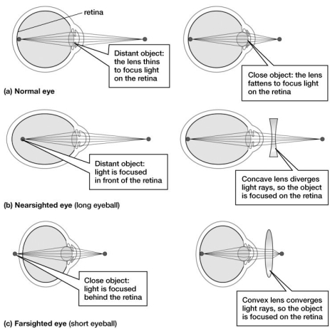 Optometrists, who help patients with their vision problems, know that certain types of repetitive use of the muscles around the lens of the eye can  train  the lens to become fatter than normal. This often occurs in truck drivers, sailors, and other people who focus on the horizon or at great distances for long periods of time. Based on this figure, which of the following would be the consequence of this, and what shape of contact lens (or lens in eyeglasses) would be prescribed?   A) nearsightedness; concave lens B) nearsightedness; convex lens C) farsightedness; concave lens D) farsightedness; convex lens