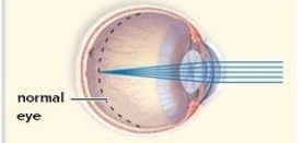 In the abnormal eyeball pictured here,the size of a normal eye is noted with a dotted line.This type of abnormality results in   A) farsightedness. B) astigmatism. C) nearsightedness. D) cataracts. E) glaucoma.