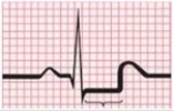 The following is noted on an ECG during exercise electrocardiography. What is this feature called?   A) PVC B) ST segment elevation C) ST segment depression D) Wide QRS duration