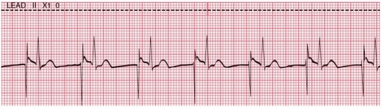 Before you perform an ECG on your patient, he informs you that he has a pacemaker but isn't sure what kind. A portion of the ECG tracing is shown here. What type of pacemaker does this patient have?   A) Atrial pacemaker B) Ventricular pacemaker C) AV pacemaker D) Atriobiventricular pacemaker