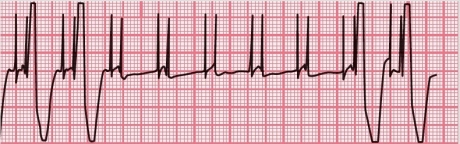 A patient known to have an AV pacemaker has been brought to the emergency department of the hospital where you work. The patient is pale, is having difficulty breathing, and is barely conscious. At the physician's request, you perform an immediate ECG. A portion of the tracing is shown here. What may be causing the patient's signs and symptoms?   A) The pacemaker is sending too many impulses, and the patient's heart cannot respond quickly enough. B) The pacemaker is functioning, but the patient's heart is not depolarizing after every impulse, leading to low cardiac output. C) The pacemaker has stopped functioning, and the patient is in cardiac arrest. D) The pacemaker is oversensing, so it is generating impulses at a slower rate than it should, resulting in a slow heart rate and low cardiac output.