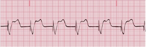 What type of pacemaker is evident in this ECG tracing?   A) Atrial pacemaker B) Ventricular pacemaker C) AV pacemaker D) Atriobiventricular pacemaker