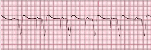 What type of pacemaker is evident in this ECG tracing?   A) Atrial pacemaker B) Ventricular pacemaker C) AV pacemaker D) Atriobiventricular pacemaker