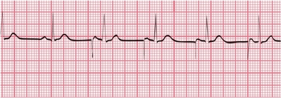 You have performed an ECG on a patient who has a pacemaker. A portion of the ECG tracing is shown here. What type of pacemaker is indicated, and at what rate is the pacemaker set?   A) Atrial pacemaker set at 64 bpm B) Atrial pacemaker set at 71 bpm C) Ventricular pacemaker set at 78 bpm D) Ventricular pacemaker set at 83 bpm