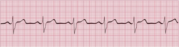 What rhythm is shown in this ECG tracing?   A) Junctional escape rhythm B) Sinus dysrhythmia with bundle branch block C) Sinus bradycardia D) Sinus bradycardia with bundle branch block