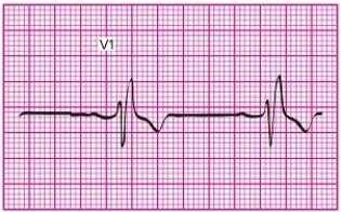 <strong>You have run a 12-lead ECG on Ms. Reilly, a patient in the cardiac care unit of the hospital where you work. A portion of the V1 tracing is shown here. What cardiac condition would you suspect based on this tracing? </strong> A)Left bundle branch block B)Right bundle branch block C)Complete AV block D)Left ventricular hypertrophy