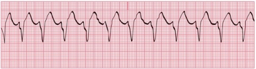 Identify the following rhythm:   A) SVT B) Ventricular tachycardia C) Ventricular fibrillation D) Accelerated idioventricular rhythm