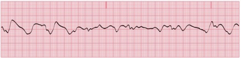 You are recording an ECG; a portion of the tracing is shown here. Your patient is pale and tells you that she is a little dizzy. Which of the following is the least likely reason for the tracing?   A) Poorly attached or dried-out electrodes B) Broken lead wires C) Excessive patient movement D) Ventricular fibrillation