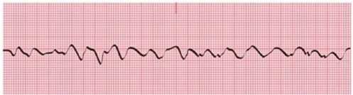 Identify the following rhythm:   A) Ventricular tachycardia B) Ventricular fibrillation C) Asystole D) SVT