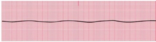 Identify the following rhythm:   A) Asystole B) Agonal C) Ventricular fibrillation D) Sinus bradycardia