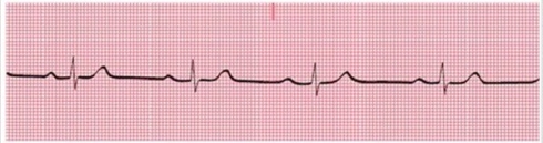 You have performed an ECG on a 34-year-old woman who appears to be in good general health. A portion of the ECG tracing is shown here. Which type of heart block does this patient have?   A) First-degree AV block B) Second-degree AV block, Mobitz type I C) Second-degree AV block, Mobitz type II D) Third-degree AV block