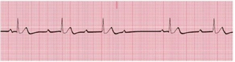 Identify the following rhythm:   A) First-degree heart block B) Second-degree AV block, Mobitz type I C) Second-degree AV block, Mobitz type II D) Third-degree AV block