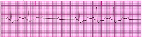 You have performed an ECG on a patient in the critical care unit at the hospital. A portion of the ECG tracing is shown below. What type of heart block does this patient have?   A) First-degree heart block B) Second-degree AV block, Mobitz type I C) Second-degree AV block, Mobitz type II D) Third-degree AV block