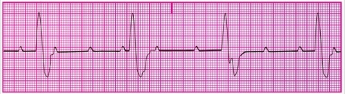 You have been asked to perform an ECG on a patient in the emergency department. The patient is pale, and while you are performing the ECG, he loses consciousness. A portion of the ECG tracing is shown below. After noting the patient's condition, what should you do?   A) Notify the licensed practitioner immediately. B) Document the rhythm and place it in the patient's chart. C) Reassure the patient's spouse that this is not a serious problem. D) Re-perform the ECG to double-check your findings.