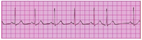 You have recorded an ECG on a patient, and a portion of the tracing is shown here. What type of dysrhythmia does this patient have?   A) Junctional tachycardia B) Junctional escape rhythm C) Accelerated junctional rhythm D) PJC