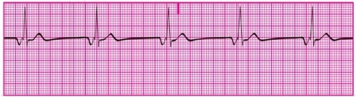 You have performed an ECG on a hospital patient who is known to be suffering from hypotension. A portion of the tracing is shown here. What might be the cause of this patient's hypotension?   A) Sinus bradycardia B) PJCs C) Junctional escape rhythm D) Accelerated junctional escape rhythm