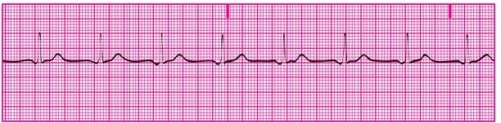 You are recording an ECG for a patient at a wellness clinic. The patient appears to be in good health and has no obvious signs or symptoms of heart trouble. A portion of the ECG tracing is shown below. What are your conclusions?   A) Normal sinus rhythm B) Sinus tachycardia C) Junctional tachycardia D) Accelerated junctional rhythm