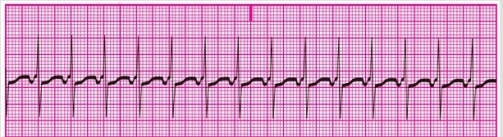 You have performed an ECG on a patient who has come to the clinic complaining of  fluttering  in his chest. A portion of the ECG tracing is shown here. What type of dysrhythmia does this patient have?   A) Sinus tachycardia B) Accelerated junctional rhythm C) Junctional tachycardia D) Ventricular tachycardia
