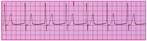 You have performed an ECG on a hospital patient. A portion of the ECG tracing is shown here. What signs and symptoms would you expect this patient to have?   A) Hypotension and confusion B) Pressure and pain in the chest C) Difficulty breathing D) No obvious symptoms