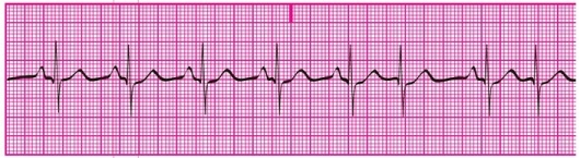 What is the underlying rhythm in the ECG tracing shown here?   A) Normal sinus rhythm B) Accelerated junctional rhythm C) Junctional tachycardia D) SVT
