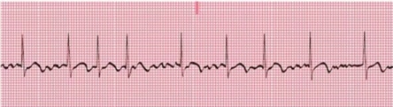 Identify the following rhythm:   A) Atrial fibrillation B) Atrial flutter C) Multifocal atrial tachycardia D) Wandering atrial pacemaker