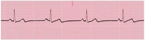 Identify the following rhythm:   A) Sinus bradycardia B) Sinus tachycardia C) Sinus dysrhythmia D) Normal sinus rhythm