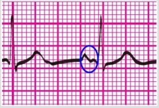The part of the ECG tracing below that is circled in blue is the:   A) QRS complex. B) P wave. C) PR interval. D) ST segment.