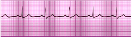 You have performed an ECG on a patient, resulting in the following ECG tracing. How would you classify the patient's rhythm?   A) Sinus bradycardia B) Sinus tachycardia C) Sinus dysrhythmia D) Normal sinus rhythm