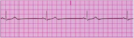 You have performed an ECG on a patient, resulting in the following ECG tracing. How would you classify the patient's rhythm?   A) Sinus bradycardia B) Sinus tachycardia C) Sinus dysrhythmia D) Normal sinus rhythm
