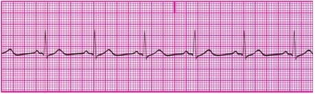 You have performed an ECG on a patient, resulting in the following ECG tracing. How would you classify the patient's rhythm?   A) Sinus bradycardia B) Sinus tachycardia C) Sinus dysrhythmia D) Normal sinus rhythm