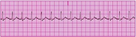 You have performed an ECG on a patient, resulting in the following ECG tracing. How would you classify the patient's rhythm?   A) Sinus arrest B) Sinus tachycardia C) Sinus dysrhythmia D) Normal sinus rhythm