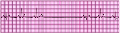 You have performed an ECG on a patient, resulting in the following ECG tracing. How would you classify the patient's rhythm?   A) Sinus bradycardia B) Sinus tachycardia C) Sinus dysrhythmia D) Sinus arrest