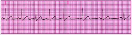 You have performed an ECG on a patient, resulting in the following ECG tracing. How would you classify the patient's rhythm?   A) Sinus bradycardia B) Sinus tachycardia C) Sinus dysrhythmia D) Sinus arrest