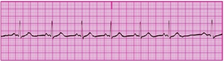 You have performed an ECG on a patient, resulting in the following ECG tracing. How would you classify the patient's rhythm?   A) Sinus bradycardia B) Sinus dysrhythmia C) Sinus tachycardia D) Normal sinus rhythm