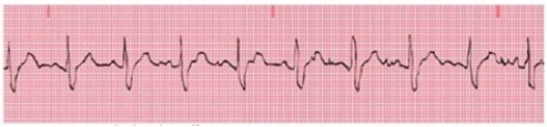 What type of artifact is shown in the figure?   A) Wandering baseline B) Somatic tremor C) Alternating current interference D) Baseline shift
