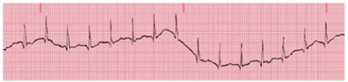What type of artifact is shown in the figure?   A) Somatic tremor B) AC interference C) Wandering baseline D) Involuntary movement