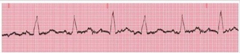 What type of artifact is shown in the figure below?   A) Somatic tremor B) AC interference C) Wandering baseline D) Involuntary movement