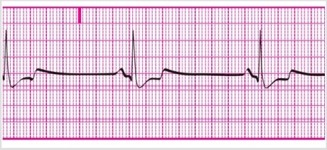 Using the 1500 method, calculate the heart rate.   A) 40 bpm B) 60 bpm C) 80 bpm D) 20 bpm