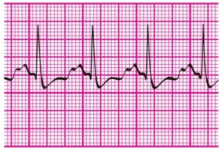 Estimate the heart rate using the R-R method.   A) 100 bpm B) 125 bpm C) 150 bpm D) 160 bpm