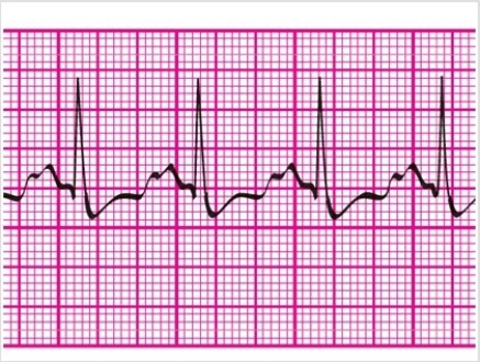 Estimate the heart rate using the 1500 method.   A) 100 bpm B) 125 bpm C) 150 bpm D) 160 bpm