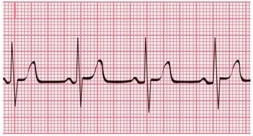 Use the 1500 method to estimate the heart rate.   A) 50 bpm B) 75 bpm C) 100 bpm D) 125 bpm