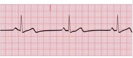 Use the R-R method to estimate the heart rate.   A) 27 bpm B) 43 bpm C) 58 bpm D) 75 bpm