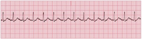 Use the 6-second method to estimate the heart rate. Note: This strip represents exactly six seconds.   A) 80 bpm B) 100 bpm C) 140 bpm D) 160 bpm