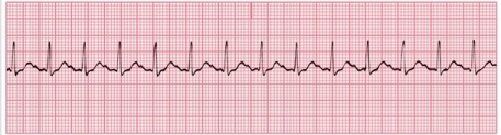 Use the 6-second method to estimate the heart rate. Note: This strip represents exactly six seconds.   A) 140 B) 84 C) 120 D) 70