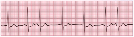 Which method of estimating heart rate should you use for this tracing, and what is the estimated heart rate?   A) R-R method, 50 bpm B) 1500 method, 58 bpm C) 1500 method, 100 bpm D) 6-second method, 70 bpm