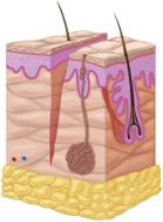   -A wound pictured here, which is clean and has a smooth cut, is a(n)  ____. A)  incision B)  laceration C)  abrasion D)  puncture E)  contusion