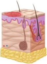   -Which type of wound, pictured here, occurs when someone slides across gravel during a softball game? A)  Puncture B)  Incision C)  Abrasion D)  Laceration E)  Contusion